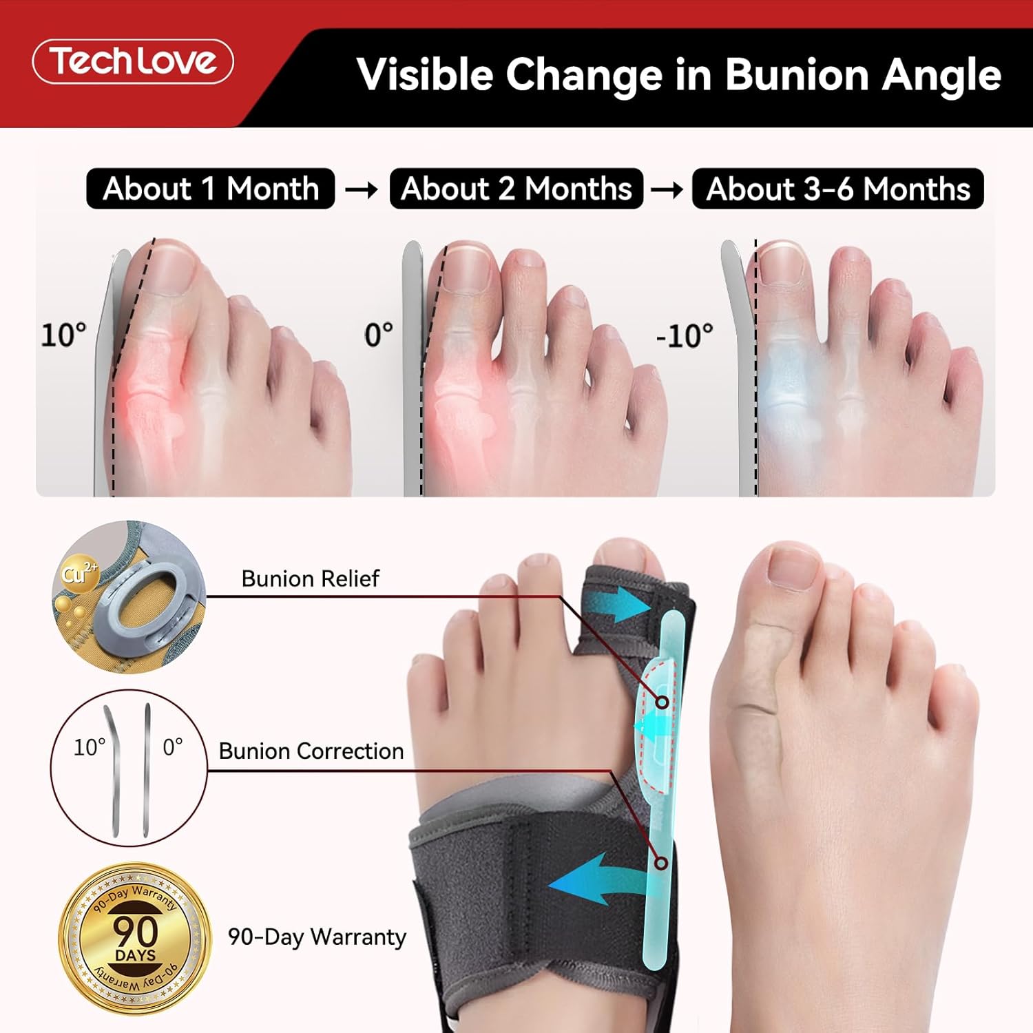 Tech Love Bunion Correction Device Changes Over Time, The bunion angle changes significantly over time.