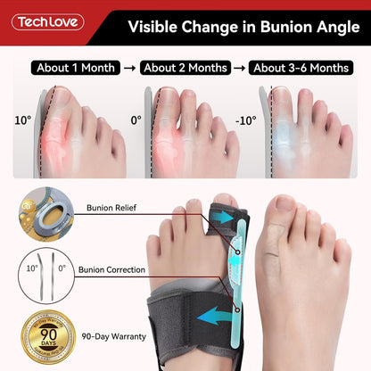 Tech Love Bunion Correction Device Changes Over Time, The bunion angle changes significantly over time.