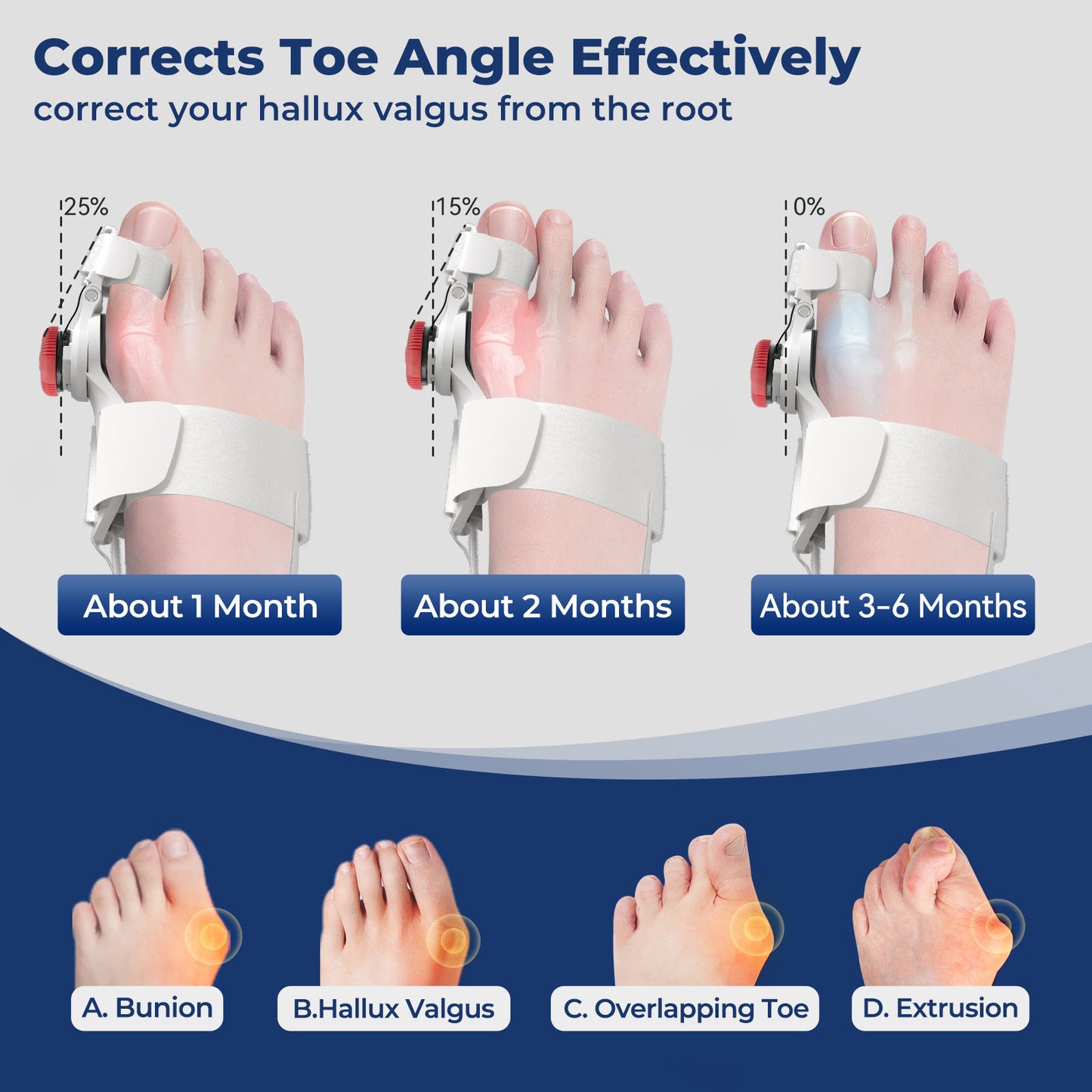 A visual timeline of bunion correction: The graphic charts a patient's progress, starting with a 25% improvement in the first month, followed by steady correction over the next several months, working to effectively realign the toe angle and correct hallux valgus from its root cause.