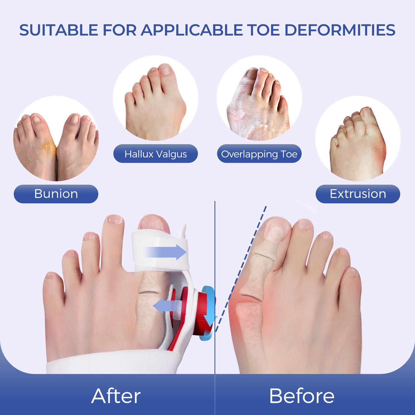 A gentleman is demonstrating the subtle changes during the process of wearing a bunion corrector, gradually returning to normal.