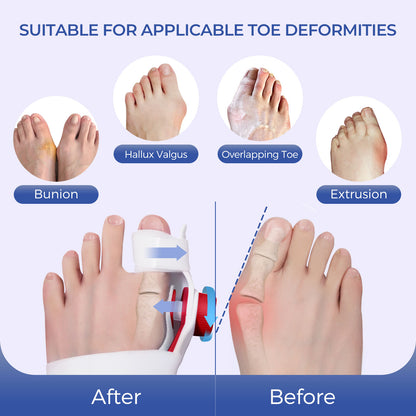 A gentleman is demonstrating the subtle changes during the process of wearing a bunion corrector, gradually returning to normal.
