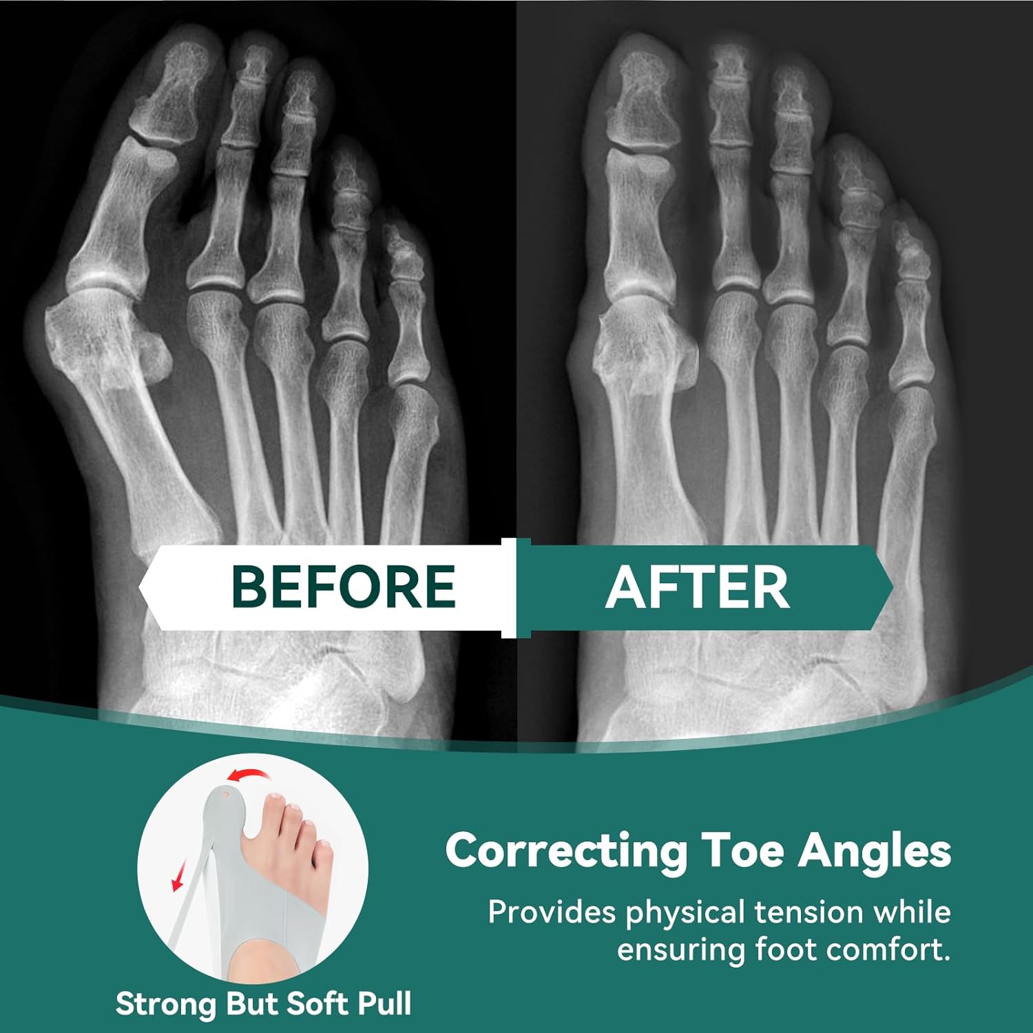 A famous woman compared her experience after wearing Tenicore bunion corrector socks and found the correction to be very effective.