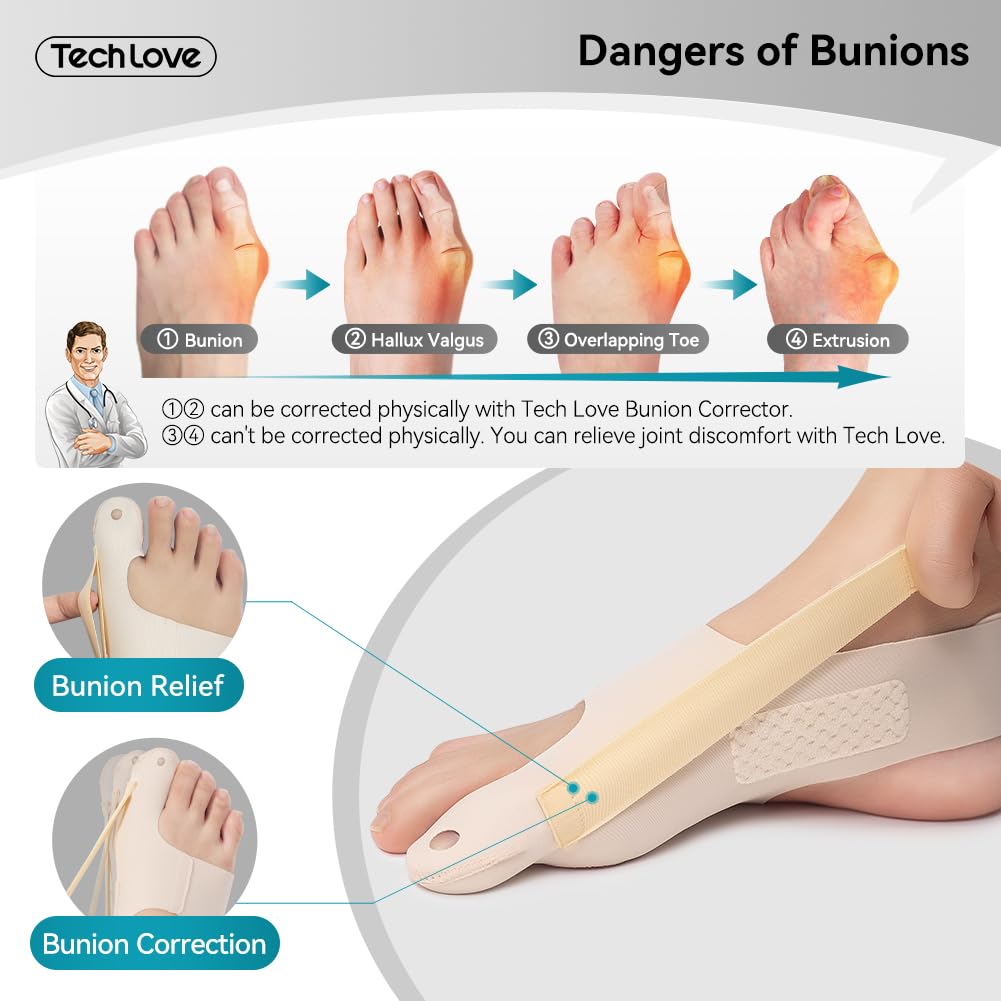 Bunion, Hallux Valgus, Overlapping Toe, and Extrusion. A podiatrist is pointing to these and explaining that problems 1 and 3 can be physically corrected or have their discomfort relieved using the TechLove orthosis, providing patients with clear solutions.